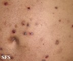 neurotic excoriations