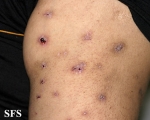 neurotic excoriations