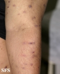 neurotic excoriations
