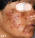 neurotic excoriations