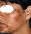 neurotic excoriations