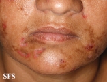 neurotic excoriations