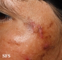 neurotic excoriations