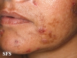 neurotic excoriations