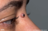 fibrous_histiocytoma-cellular_fibrous_histiocytoma