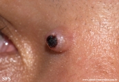 fibrous_histiocytoma-cellular_fibrous_histiocytoma