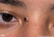 fibrous_histiocytoma-cellular_fibrous_histiocytoma