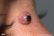 fibrous_histiocytoma-cellular_fibrous_histiocytoma