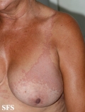 granuloma annulare-contact granuloma annulare