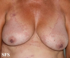 granuloma annulare-contact granuloma annulare