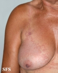 granuloma annulare-contact granuloma annulare