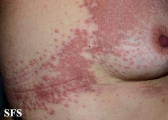 granuloma annulare-contact granuloma annulare