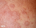 granuloma annulare-contact granuloma annulare