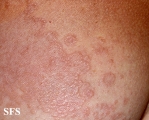 granuloma annulare-contact granuloma annulare