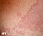 granuloma annulare-contact granuloma annulare