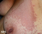 granuloma annulare-contact granuloma annulare