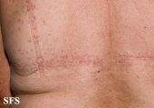 granuloma annulare-contact granuloma annulare