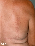 granuloma annulare-contact granuloma annulare