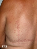 granuloma annulare-contact granuloma annulare