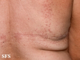 granuloma annulare-contact granuloma annulare