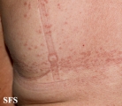granuloma annulare-contact granuloma annulare