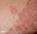 granuloma annulare-contact granuloma annulare