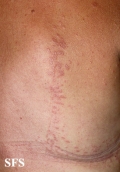 granuloma annulare-contact granuloma annulare