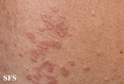 granuloma annulare-contact granuloma annulare