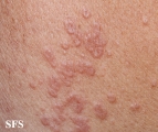 granuloma annulare-contact granuloma annulare