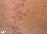 granuloma annulare-contact granuloma annulare