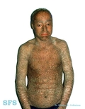 lamellar icthyosis