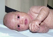 lamellar icthyosis