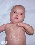 lamellar icthyosis