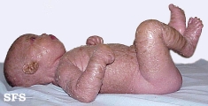 lamellar icthyosis