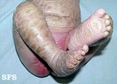 lamellar icthyosis