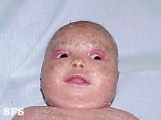 lamellar icthyosis