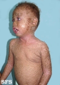lamellar icthyosis