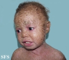 lamellar icthyosis