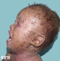 lamellar icthyosis