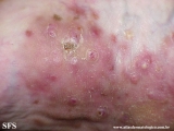 mycetoma