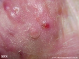 mycetoma