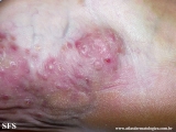 mycetoma