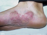 mycetoma