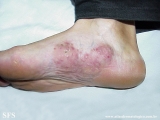 mycetoma