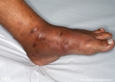 mycetoma