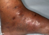 mycetoma