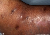 mycetoma