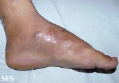 mycetoma