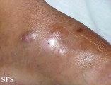 mycetoma