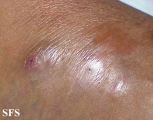 mycetoma